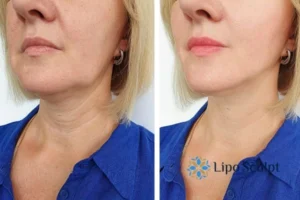 Double chin before and after Hi-Fu treatment 4 Book your double chin treatment West Yorkshire today! We are here to help!