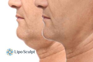 Double chin before and after Hi-Fu treatment 2 Double chin treatment West Yorkshire from Lipo Sculpt - feel more confident today!